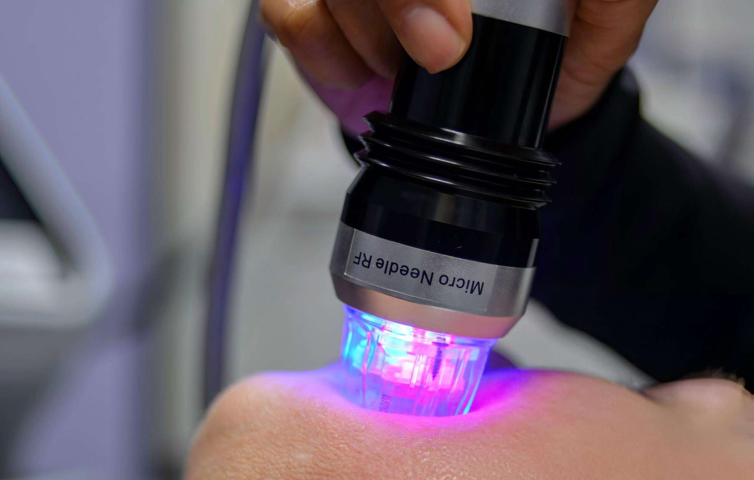 RF Microneedling results